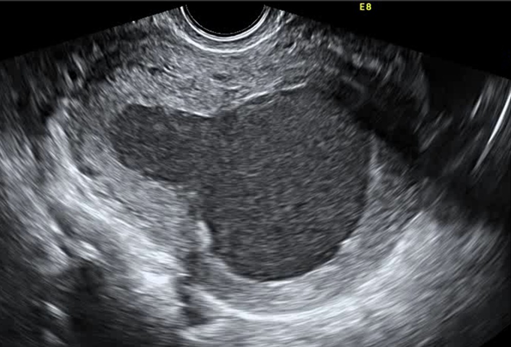 Артеріо-венозна мальформація матки після медикаментозного аборту: клінічний випадок