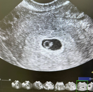 Мужской фактор бесплодия, миома матки и 15 лет ожидания: из практики врача Марты Грицко