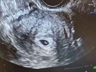 Один здоровий ембріон як шанс на нову вагітність: випадок лікаря Віталія Радька