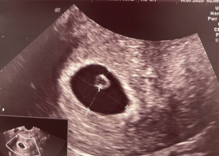 Історія з практики: як жінка з АМГ 0,14 стала мамою