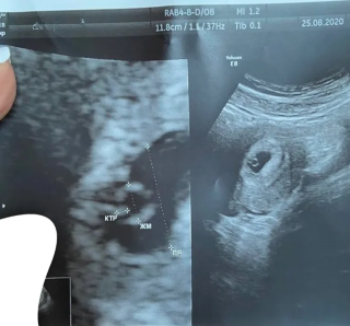 Проєкт «Лелека прилетить»: як Ірина та Євгеній стали батьками Матвія завдяки ЕКЗ