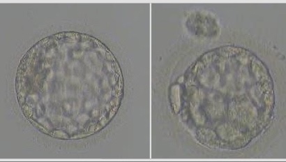 Історія з практики лікарки Загребельської Анастасії: шлях до материнства попри низький оваріальний резерв