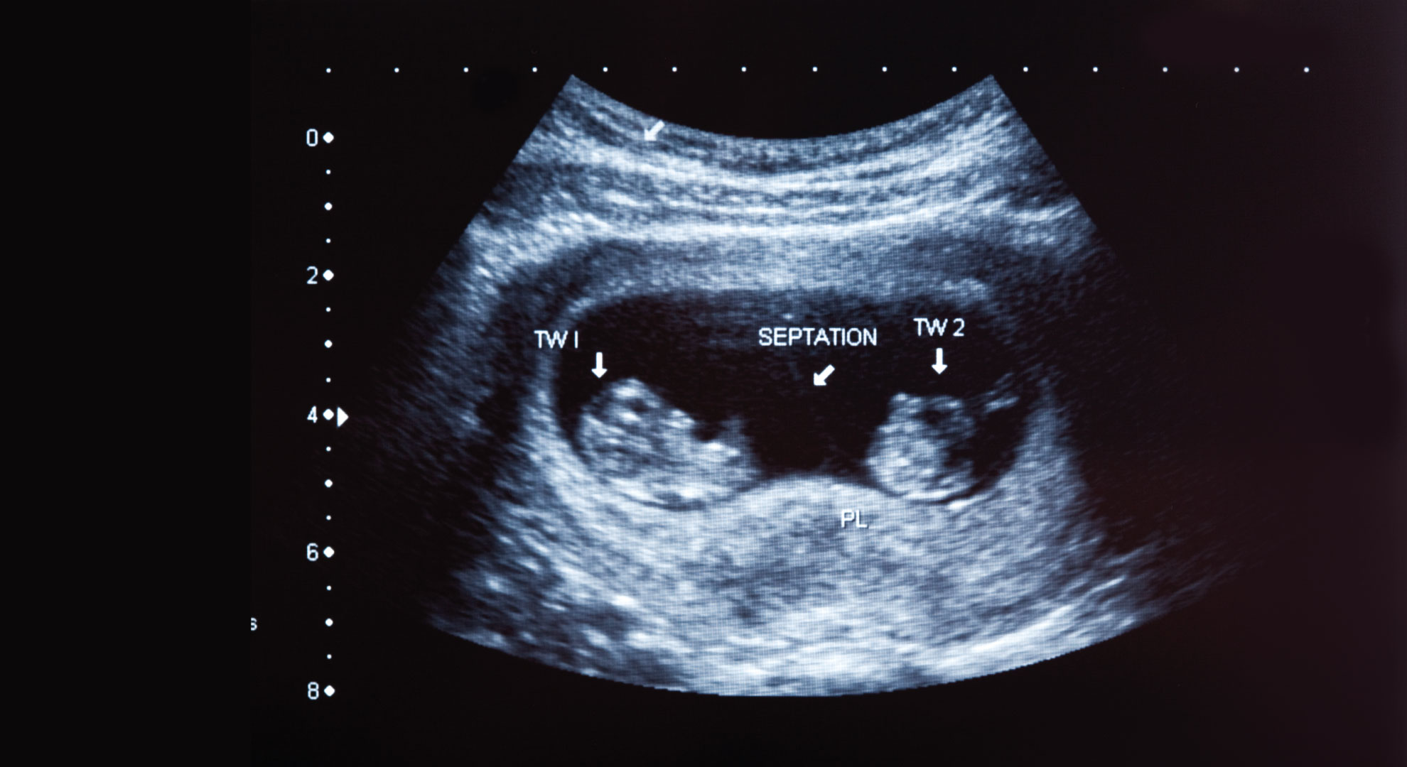 Багатоплідна вагітність - фото 1